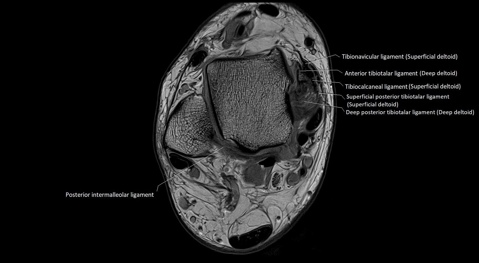 MRI ankle ligaments anatomy axial 3T image 7.webp